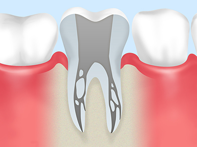 重度のむし歯は根から治します
