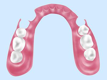 自費の入れ歯