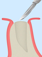 STEP1：歯ぐきの切開