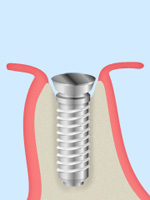 STEP3：インプラント埋入