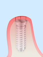 STEP4：歯ぐきの縫合