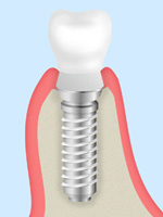 STEP6：人工歯の装着