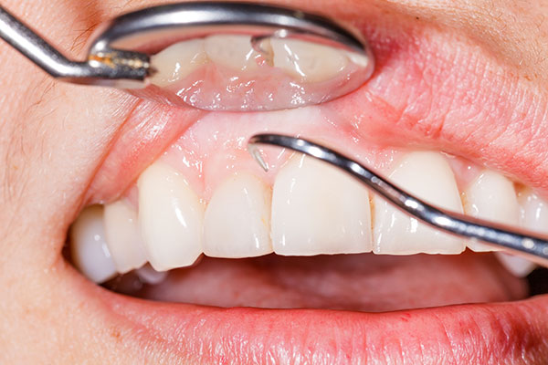 歯ぐきの腫れや出血は歯周病かもしれません