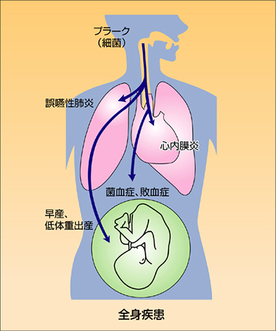 歯周病が全身に与える影響